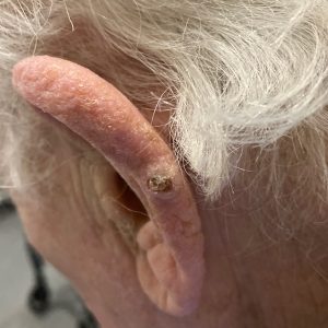 Squamous Cell Carcinoma of the ear