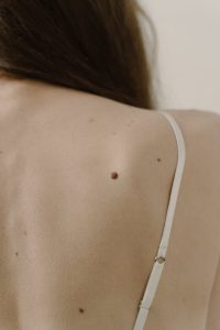 Skin Checks Mt Barker SA- moles on back